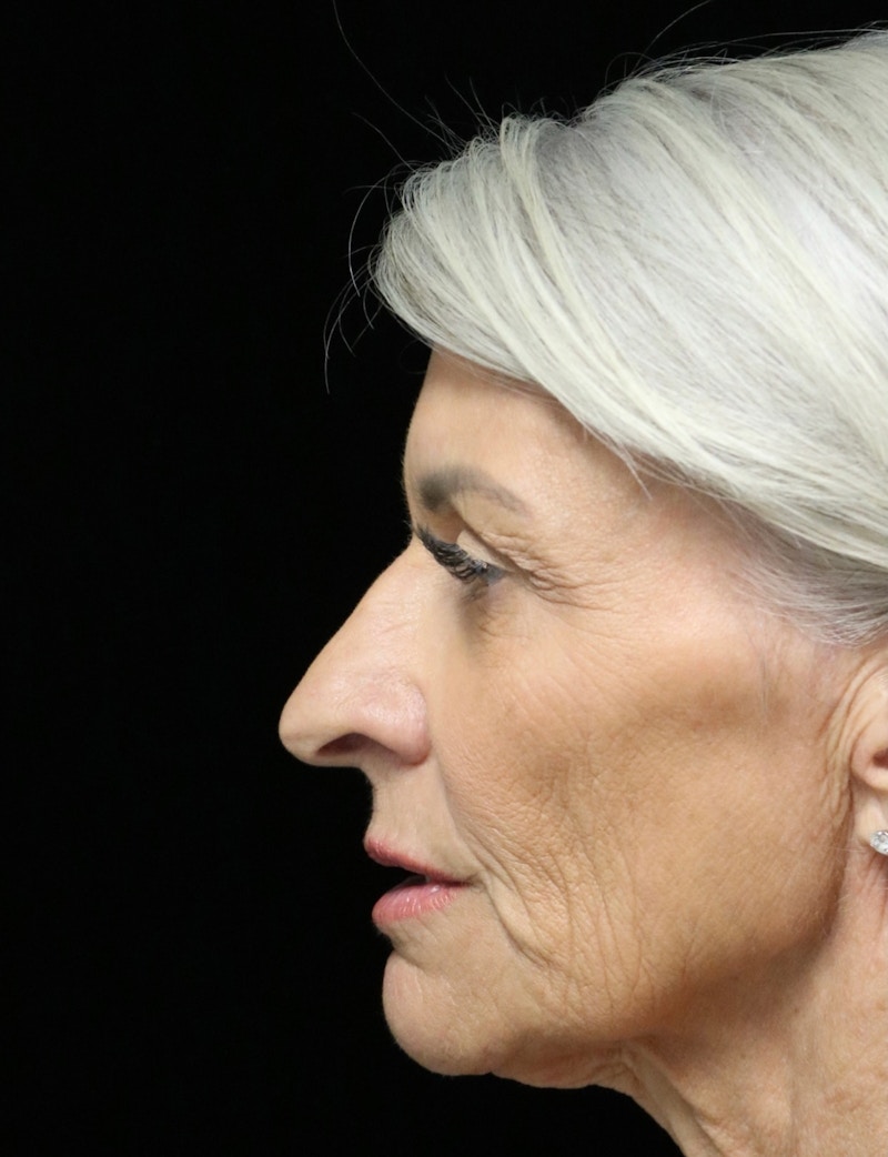 Beverly Hills Rhinoplasty Before & After Gallery - Patient 405025 - Image 5 Dr. Deepak Raj Dugar