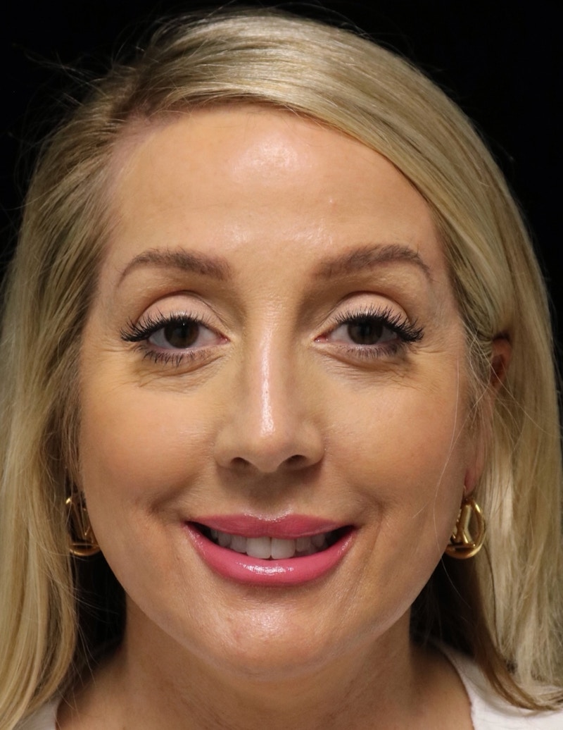 Beverly Hills Rhinoplasty Before & After Gallery - Patient 136890 - Image 12 Dr. Deepak Raj Dugar