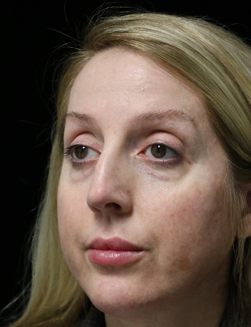 Beverly Hills Rhinoplasty Before & After Gallery - Patient 136890 - Image 7 Dr. Deepak Raj Dugar