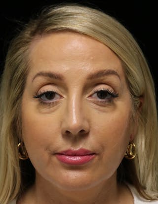 Beverly Hills Rhinoplasty Before & After Gallery - Patient 136890 - Image 10 Dr. Deepak Raj Dugar