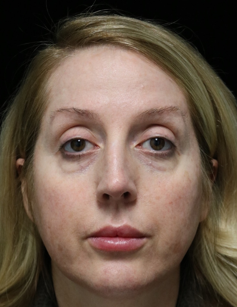 Beverly Hills Rhinoplasty Before & After Gallery - Patient 136890 - Image 9 Dr. Deepak Raj Dugar