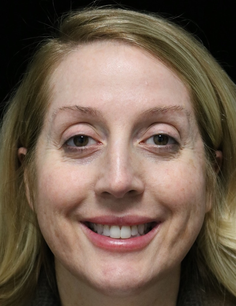 Beverly Hills Rhinoplasty Before & After Gallery - Patient 136890 - Image 11 Dr. Deepak Raj Dugar