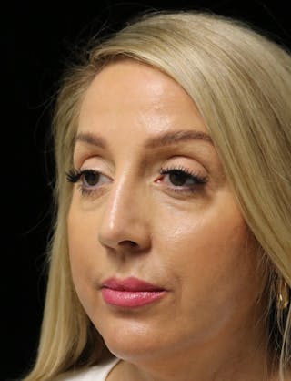 Beverly Hills Rhinoplasty Before & After Gallery - Patient 136890 - Image 8 Dr. Deepak Raj Dugar