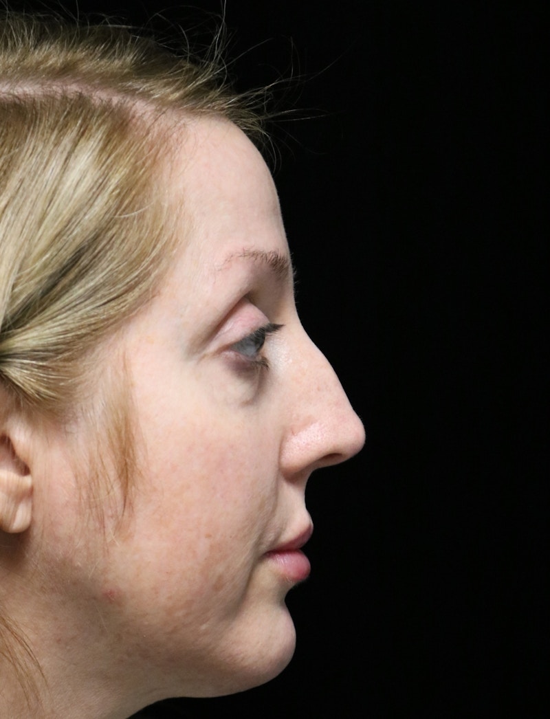 Beverly Hills Rhinoplasty Before & After Gallery - Patient 136890 - Image 1 Dr. Deepak Raj Dugar