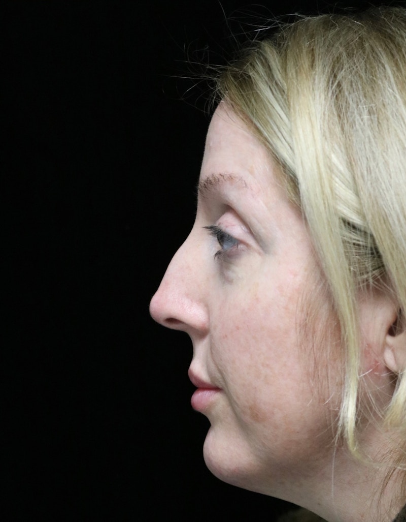 Beverly Hills Rhinoplasty Before & After Gallery - Patient 136890 - Image 5 Dr. Deepak Raj Dugar