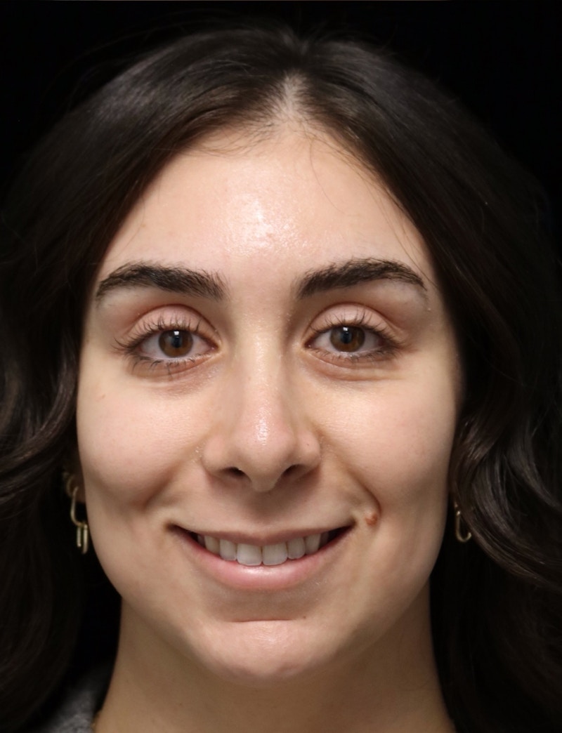 Beverly Hills Rhinoplasty Before & After Gallery - Patient 650330 - Image 12 Dr. Deepak Raj Dugar