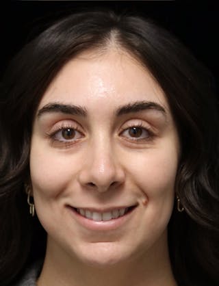 Beverly Hills Rhinoplasty Before & After Gallery - Patient 650330 - Image 12 Dr. Deepak Raj Dugar