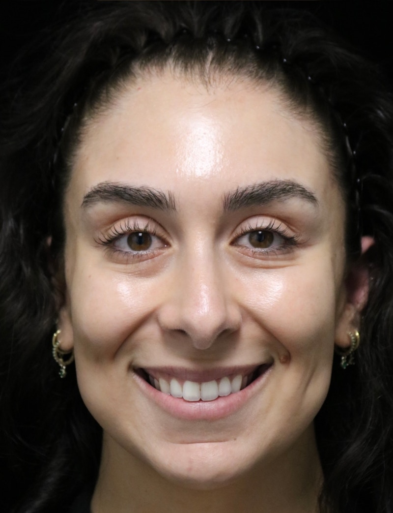 Beverly Hills Rhinoplasty Before & After Gallery - Patient 650330 - Image 11 Dr. Deepak Raj Dugar