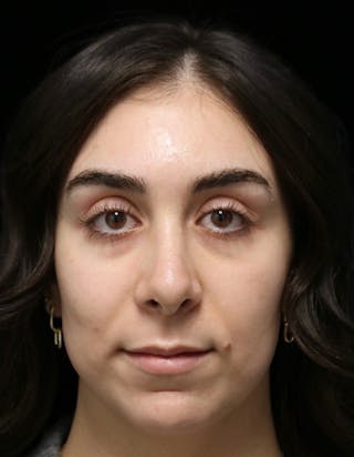 Beverly Hills Rhinoplasty Before & After Gallery - Patient 650330 - Image 10 Dr. Deepak Raj Dugar