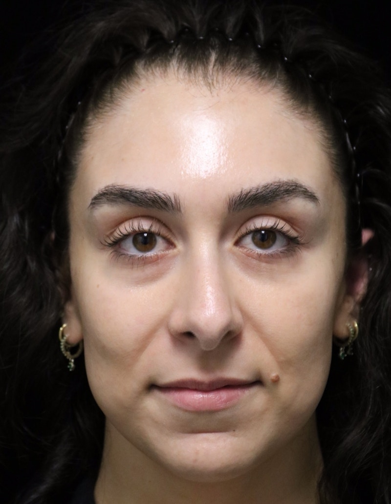 Beverly Hills Rhinoplasty Before & After Gallery - Patient 650330 - Image 9 Dr. Deepak Raj Dugar