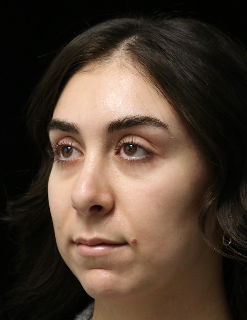 Beverly Hills Rhinoplasty Before & After Gallery - Patient 650330 - Image 8 Dr. Deepak Raj Dugar