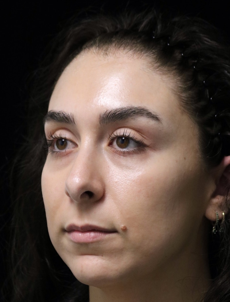 Beverly Hills Rhinoplasty Before & After Gallery - Patient 650330 - Image 7 Dr. Deepak Raj Dugar