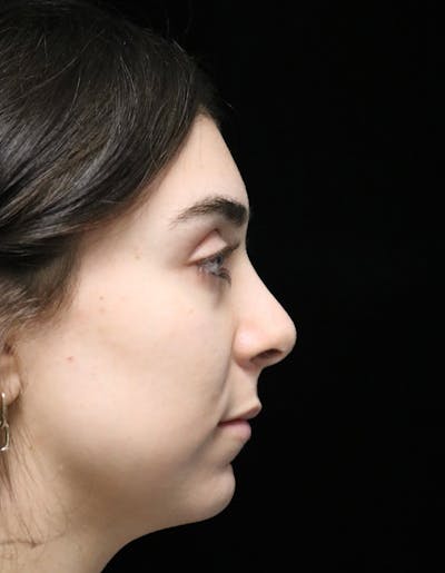 Beverly Hills Rhinoplasty Before & After Gallery - Patient 650330 - Image 2 Dr. Deepak Raj Dugar