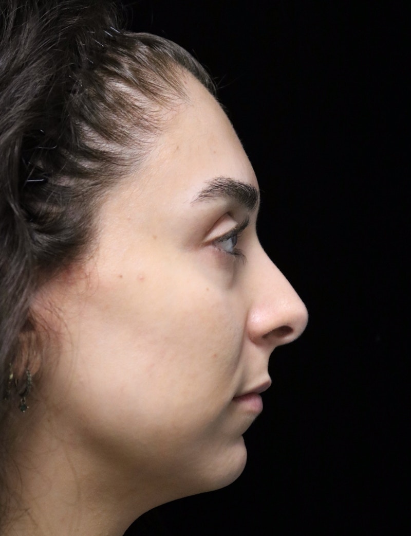 Beverly Hills Rhinoplasty Before & After Gallery - Patient 650330 - Image 1 Dr. Deepak Raj Dugar