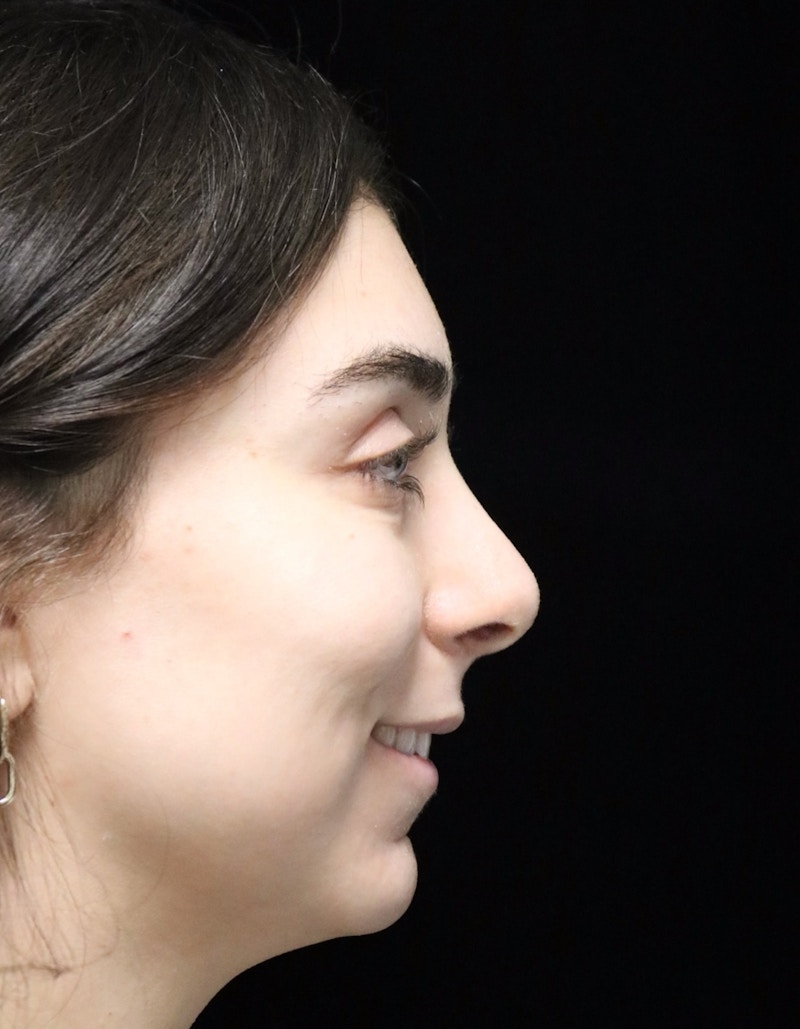 Beverly Hills Rhinoplasty Before & After Gallery - Patient 650330 - Image 4 Dr. Deepak Raj Dugar