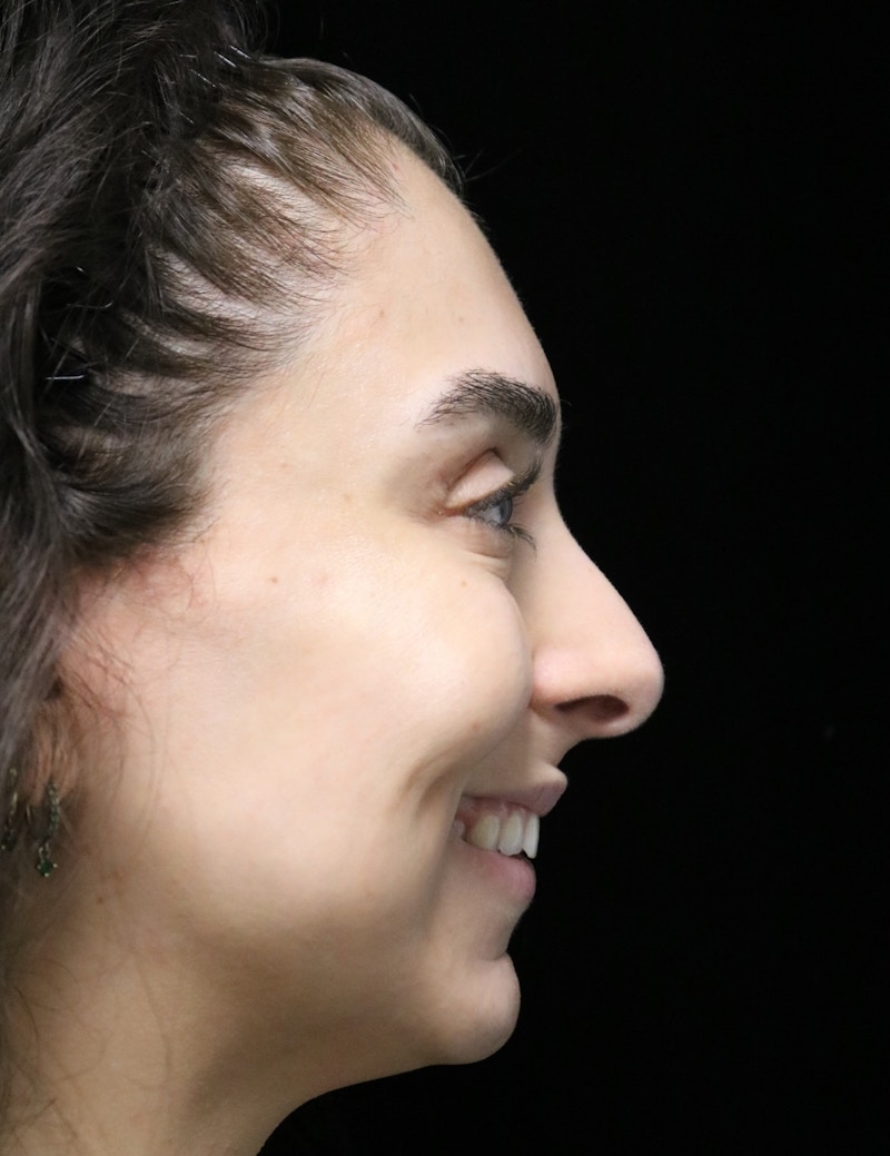 Beverly Hills Rhinoplasty Before & After Gallery - Patient 650330 - Image 3 Dr. Deepak Raj Dugar
