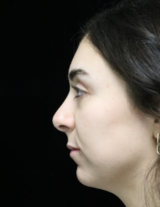 Beverly Hills Rhinoplasty Before & After Gallery - Patient 650330 - Image 6 Dr. Deepak Raj Dugar