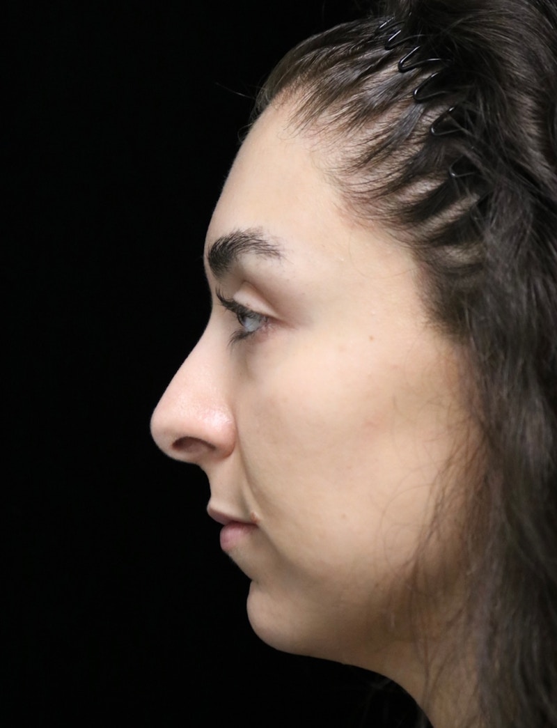 Beverly Hills Rhinoplasty Before & After Gallery - Patient 650330 - Image 5 Dr. Deepak Raj Dugar