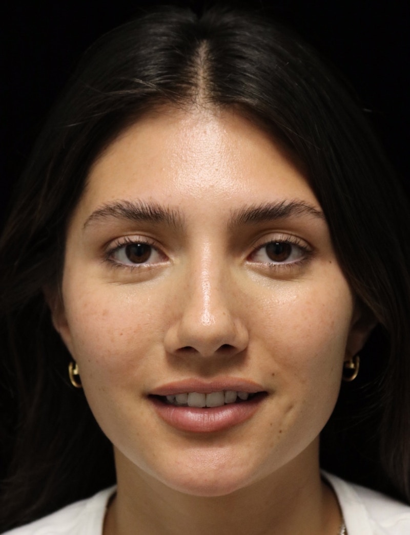 Beverly Hills Rhinoplasty Before & After Gallery - Patient 355341 - Image 11 Dr. Deepak Raj Dugar