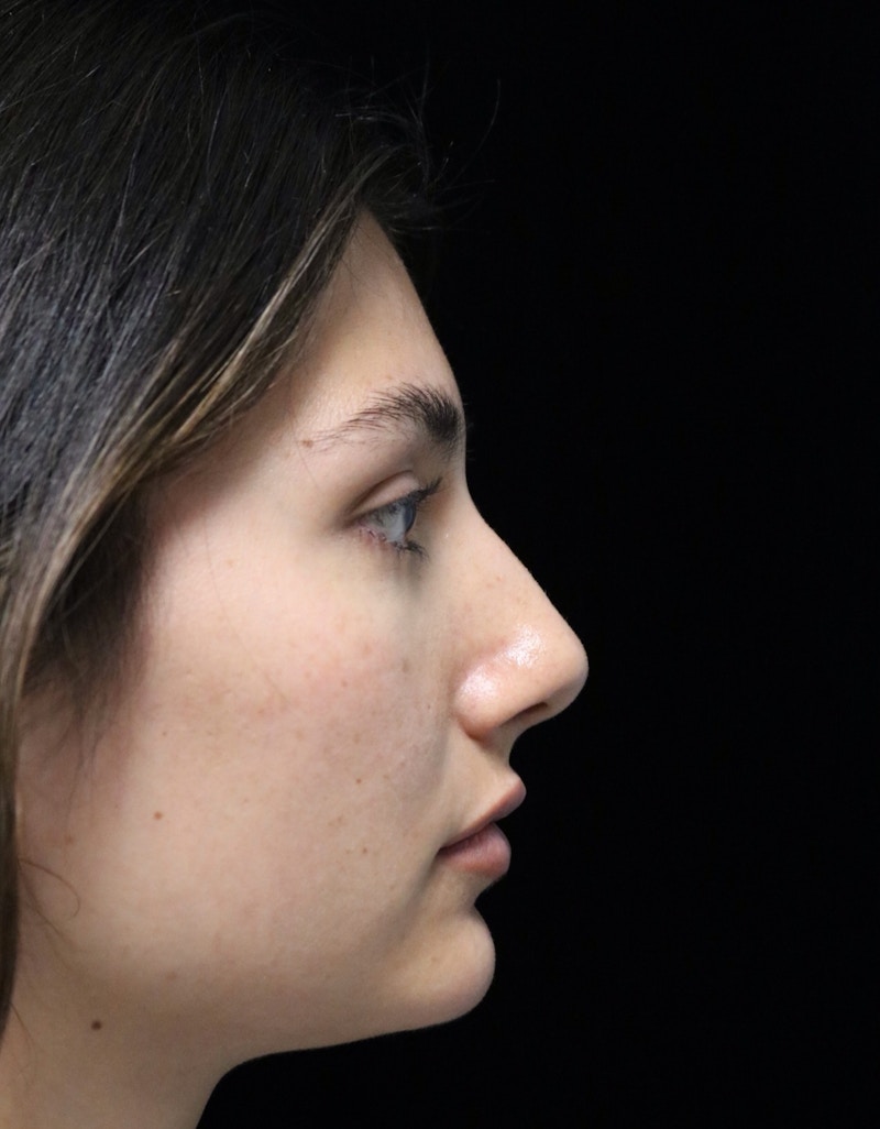 Beverly Hills Rhinoplasty Before & After Gallery - Patient 355341 - Image 1 Dr. Deepak Raj Dugar
