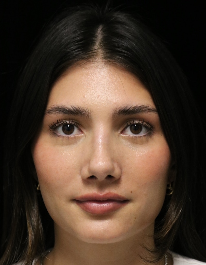 Beverly Hills Rhinoplasty Before & After Gallery - Patient 355341 - Image 10 Dr. Deepak Raj Dugar