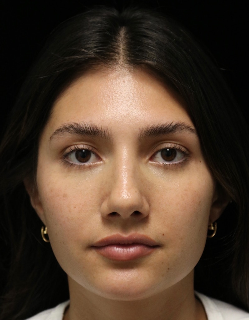 Beverly Hills Rhinoplasty Before & After Gallery - Patient 355341 - Image 9 Dr. Deepak Raj Dugar