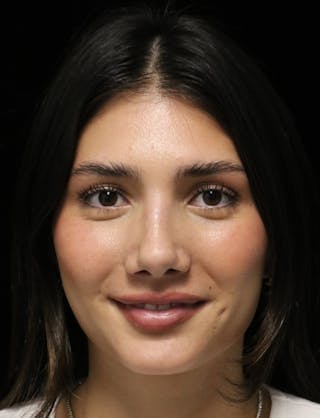 Beverly Hills Rhinoplasty Before & After Gallery - Patient 355341 - Image 12 Dr. Deepak Raj Dugar