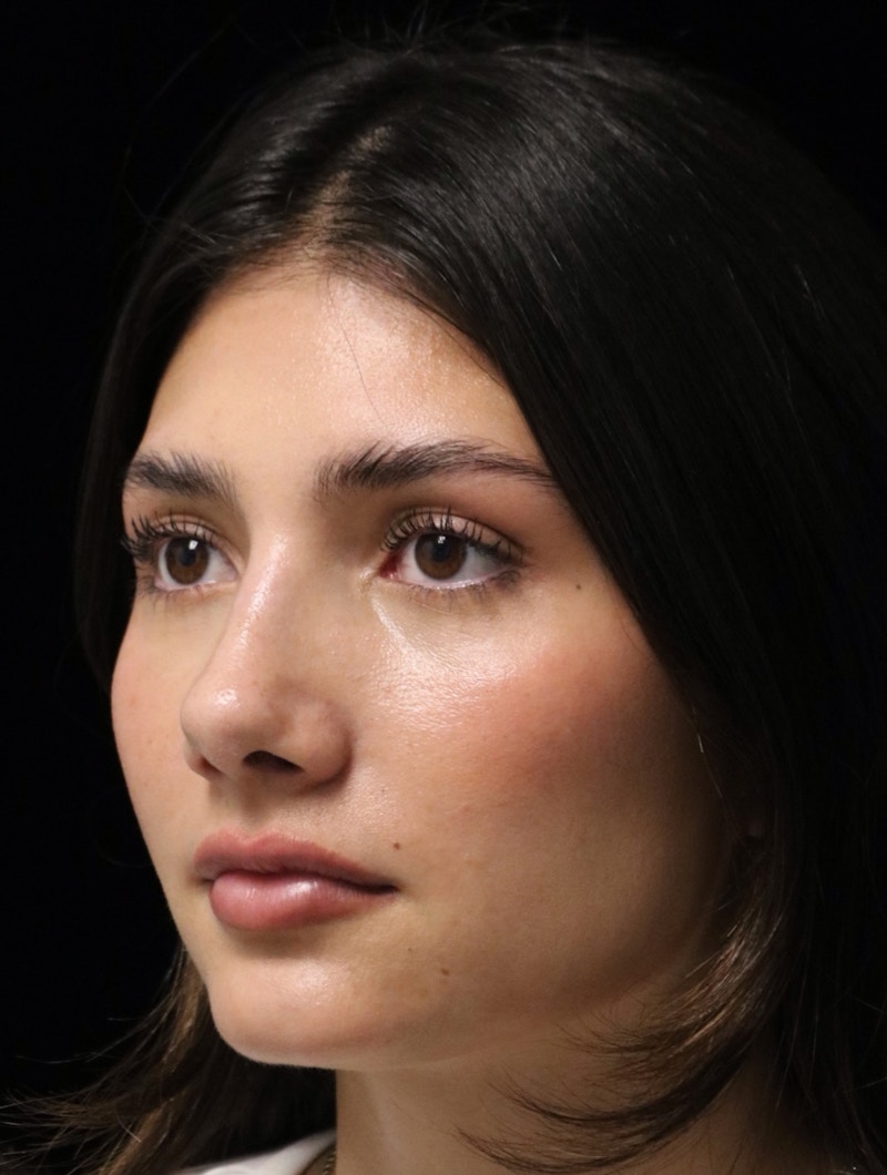 Beverly Hills Rhinoplasty Before & After Gallery - Patient 355341 - Image 8 Dr. Deepak Raj Dugar