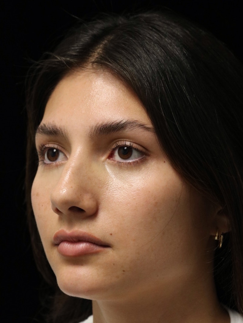 Beverly Hills Rhinoplasty Before & After Gallery - Patient 355341 - Image 7 Dr. Deepak Raj Dugar