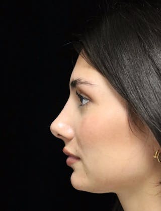 Beverly Hills Rhinoplasty Before & After Gallery - Patient 355341 - Image 6 Dr. Deepak Raj Dugar