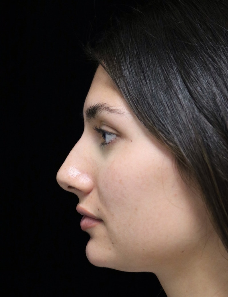 Beverly Hills Rhinoplasty Before & After Gallery - Patient 355341 - Image 5 Dr. Deepak Raj Dugar