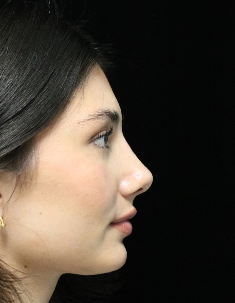Beverly Hills Rhinoplasty Before & After Gallery - Patient 355341 - Image 2 Dr. Deepak Raj Dugar