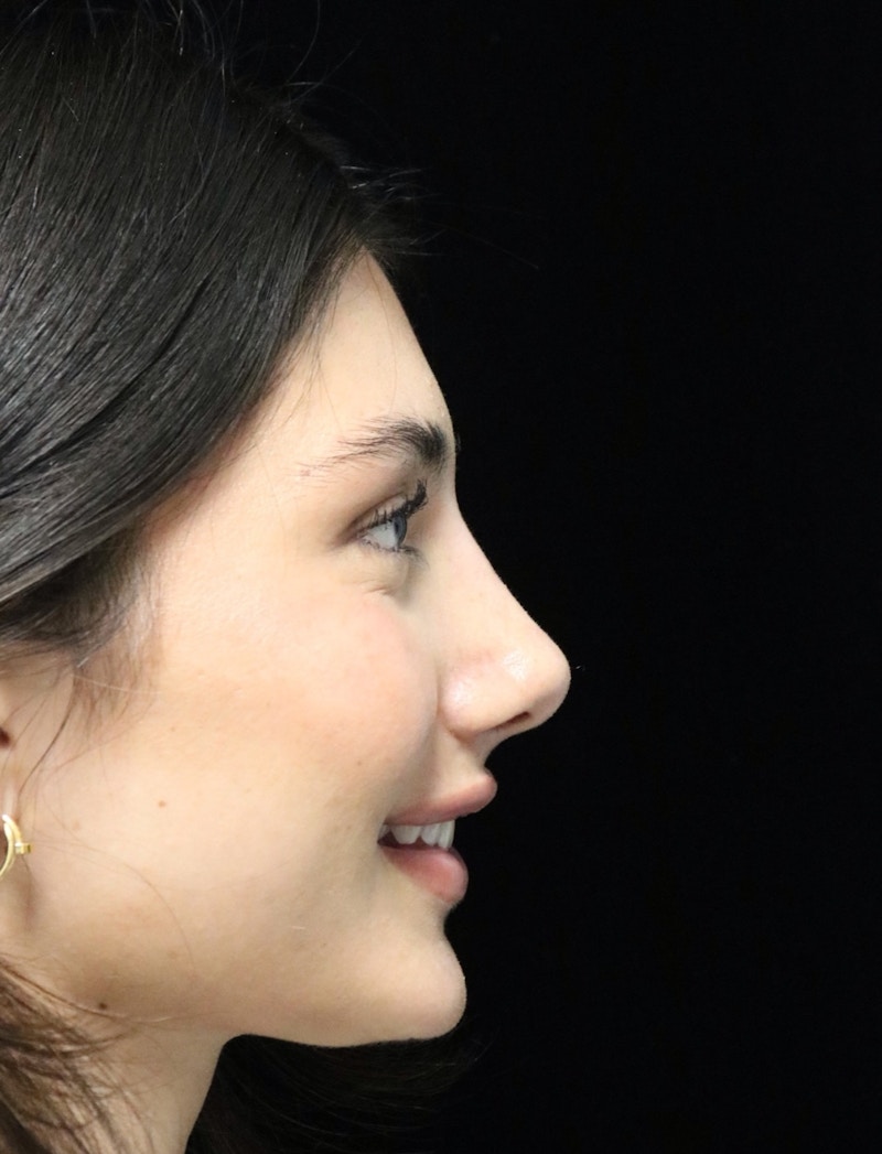 Beverly Hills Rhinoplasty Before & After Gallery - Patient 355341 - Image 4 Dr. Deepak Raj Dugar