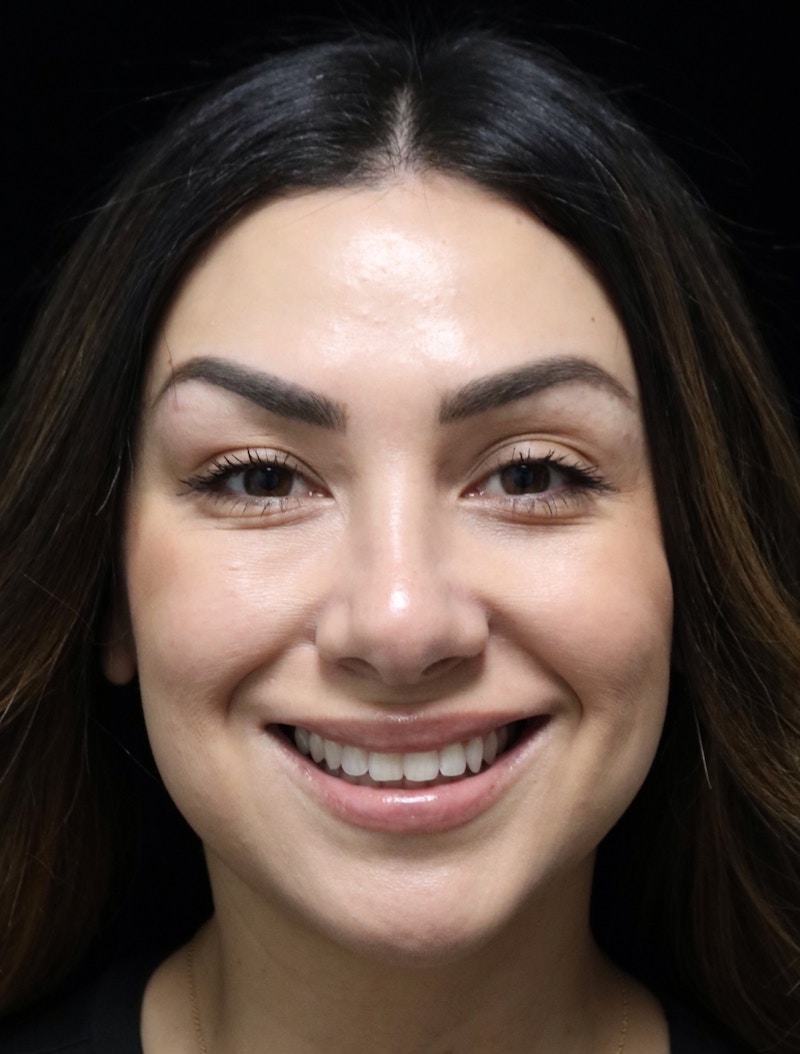 Beverly Hills Rhinoplasty Before & After Gallery - Patient 303519 - Image 12 Dr. Deepak Raj Dugar