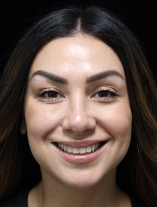 Beverly Hills Rhinoplasty Before & After Gallery - Patient 303519 - Image 12 Dr. Deepak Raj Dugar