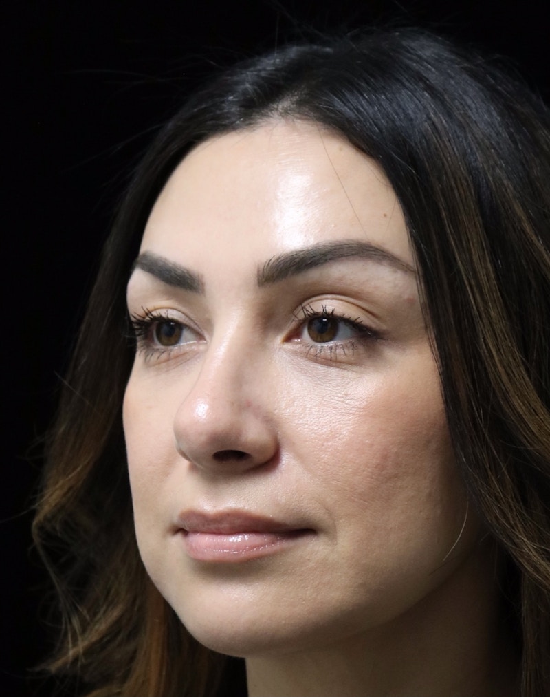 Beverly Hills Rhinoplasty Before & After Gallery - Patient 303519 - Image 8 Dr. Deepak Raj Dugar