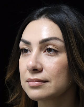 Beverly Hills Rhinoplasty Before & After Gallery - Patient 303519 - Image 8 Dr. Deepak Raj Dugar