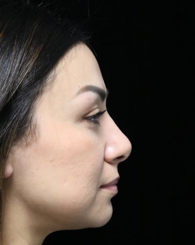 Beverly Hills Rhinoplasty Before & After Gallery - Patient 303519 - Image 2 Dr. Deepak Raj Dugar