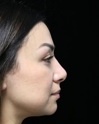Beverly Hills Rhinoplasty Before & After Gallery - Patient 303519 - Image 2 Dr. Deepak Raj Dugar