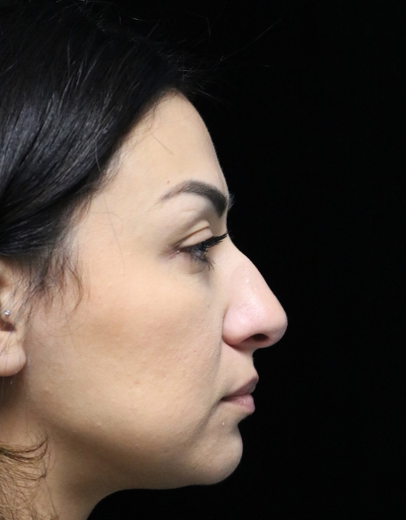 Beverly Hills Rhinoplasty Before & After Gallery - Patient 303519 - Image 1 Dr. Deepak Raj Dugar