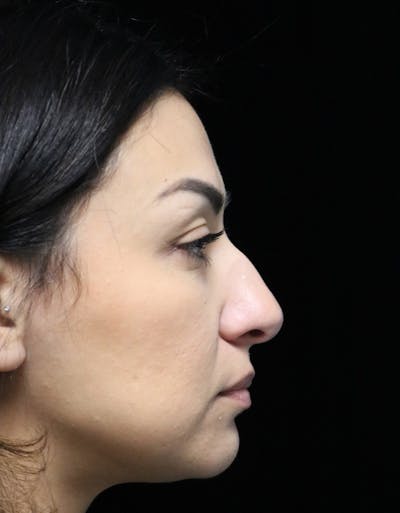 Rhinoplasty Before & After Gallery - Patient 303519 - Image 1