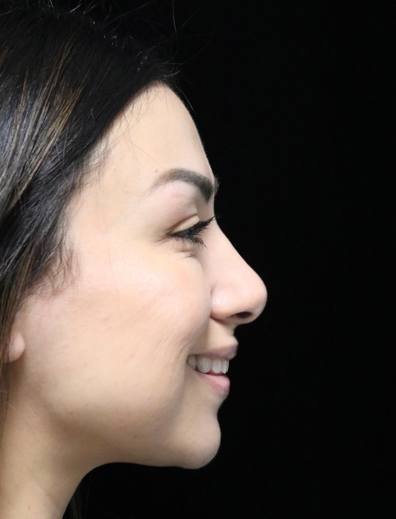 Beverly Hills Rhinoplasty Before & After Gallery - Patient 303519 - Image 4 Dr. Deepak Raj Dugar