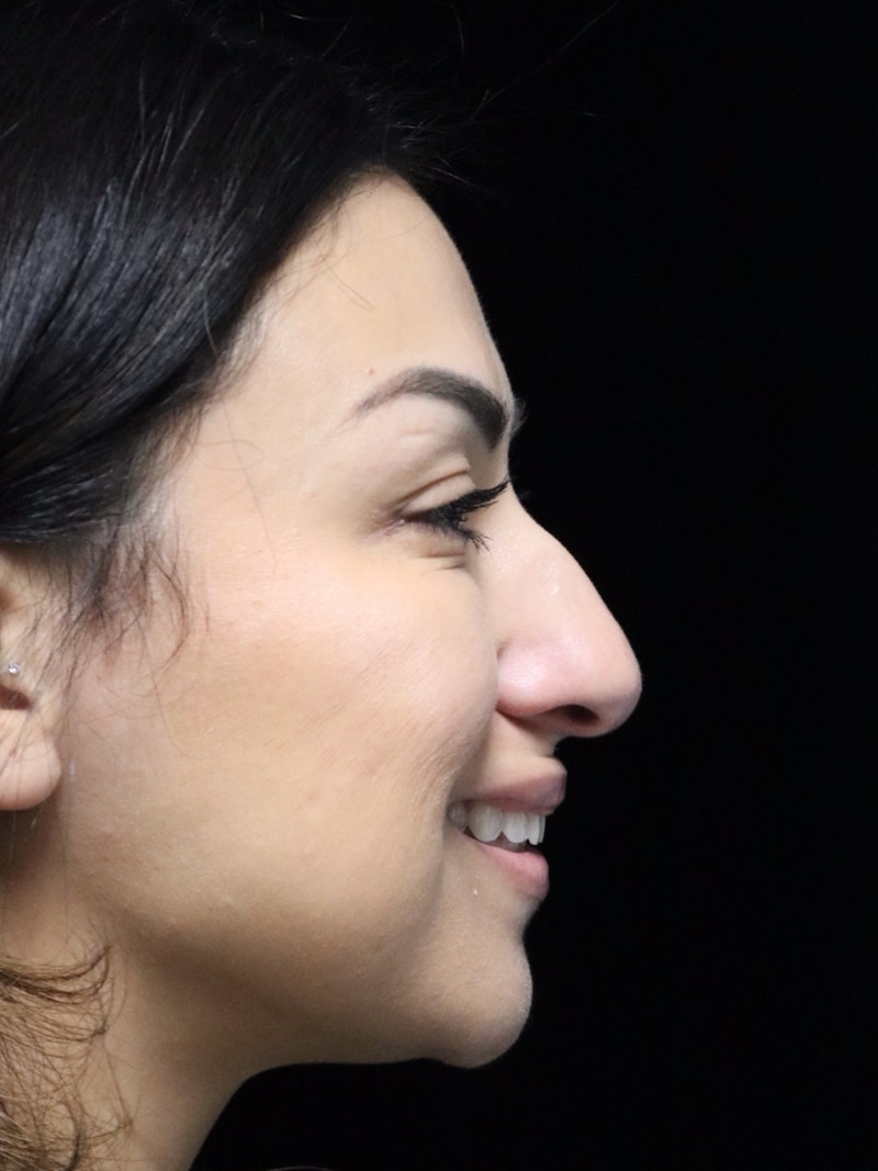 Beverly Hills Rhinoplasty Before & After Gallery - Patient 303519 - Image 3 Dr. Deepak Raj Dugar
