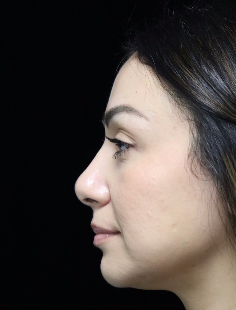 Beverly Hills Rhinoplasty Before & After Gallery - Patient 303519 - Image 6 Dr. Deepak Raj Dugar