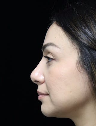 Beverly Hills Rhinoplasty Before & After Gallery - Patient 303519 - Image 6 Dr. Deepak Raj Dugar