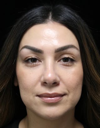 Beverly Hills Rhinoplasty Before & After Gallery - Patient 303519 - Image 10 Dr. Deepak Raj Dugar