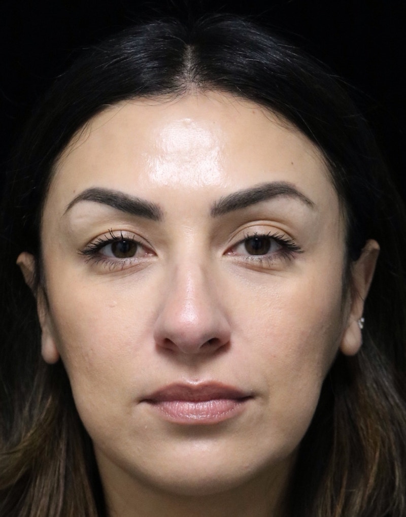 Beverly Hills Rhinoplasty Before & After Gallery - Patient 303519 - Image 9 Dr. Deepak Raj Dugar