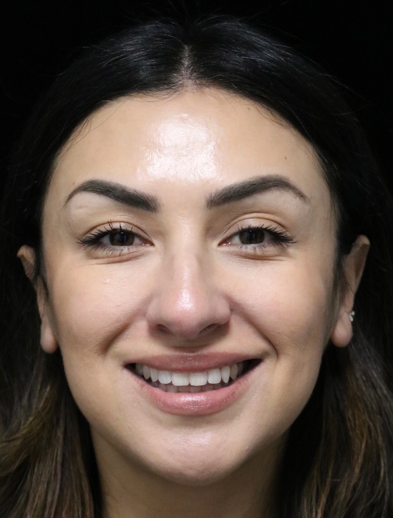 Beverly Hills Rhinoplasty Before & After Gallery - Patient 303519 - Image 11 Dr. Deepak Raj Dugar