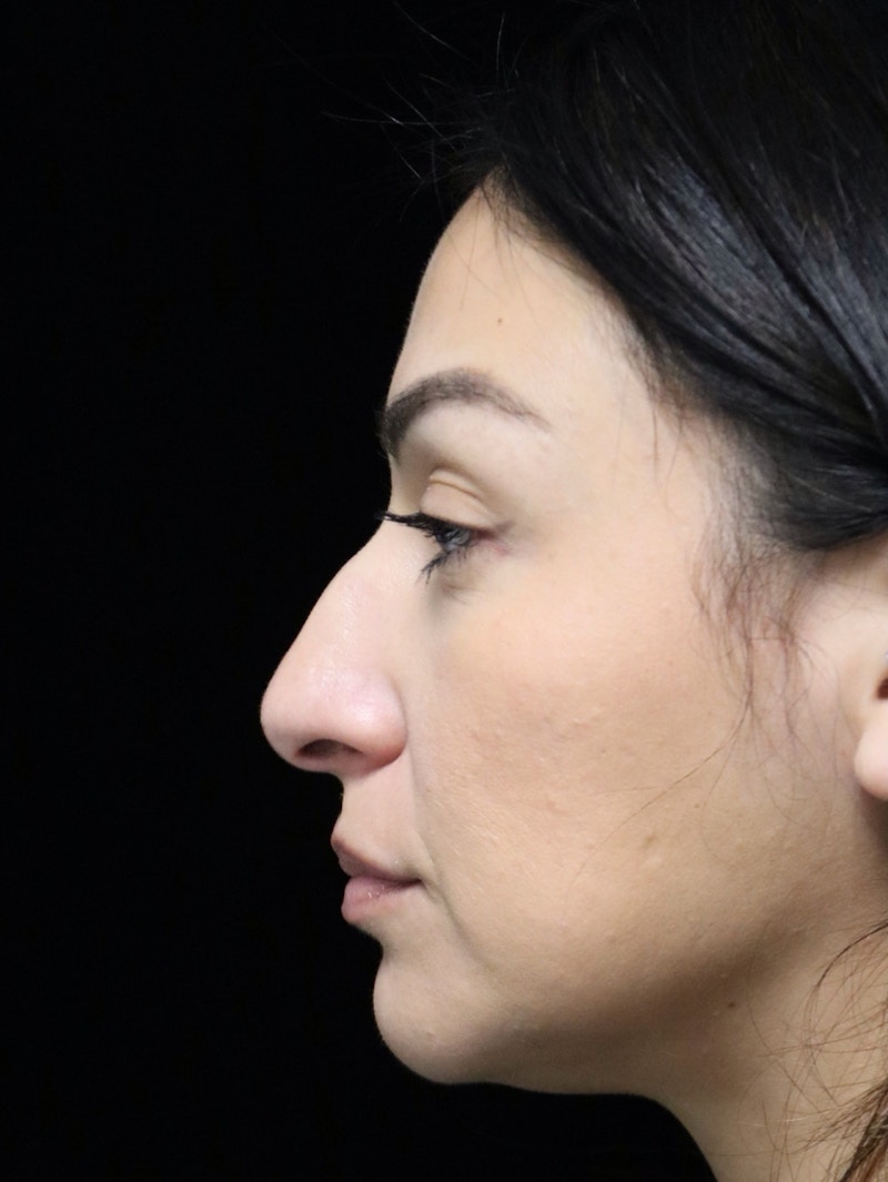 Beverly Hills Rhinoplasty Before & After Gallery - Patient 303519 - Image 5 Dr. Deepak Raj Dugar