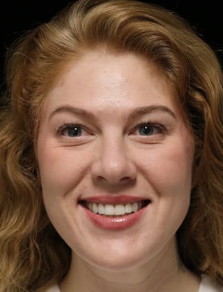 Beverly Hills Rhinoplasty Before & After Gallery - Patient 675227 - Image 12 Dr. Deepak Raj Dugar